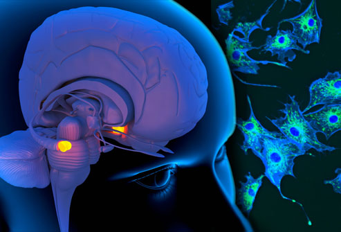 webmd rm photo of brain and nerve cells