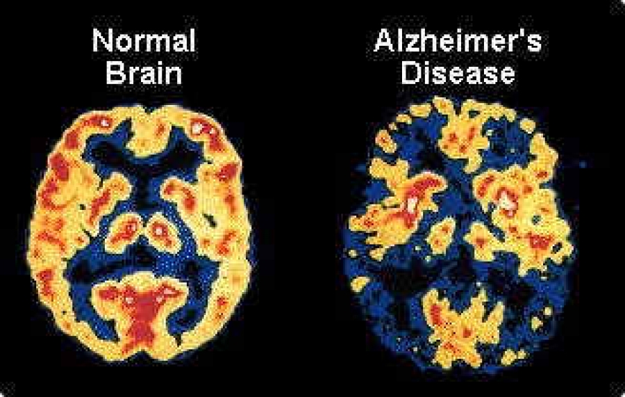 Bệnh Alzheimer ở người trẻ tuổi: Còn trẻ mà nhớ nhớ quên quên, coi chừng mắc bệnh nguy hiểm  - Ảnh 3.